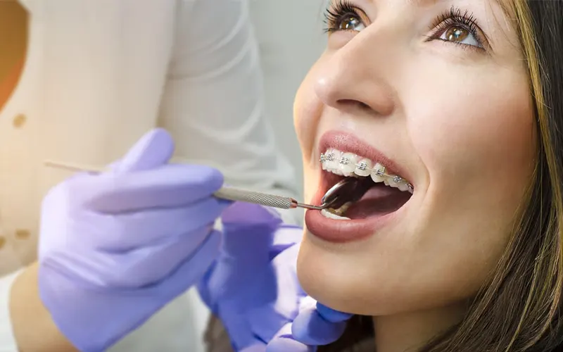 نکات مراقبتی در ارتودنسی