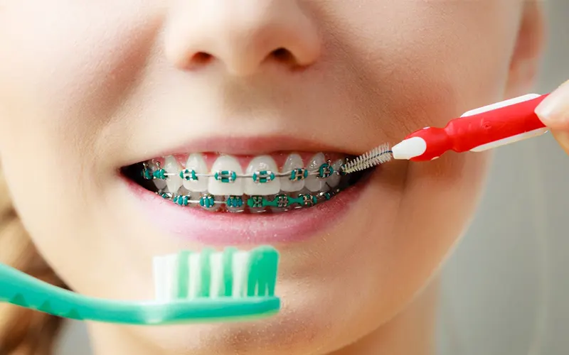 نکات مراقبتی در ارتودنسی