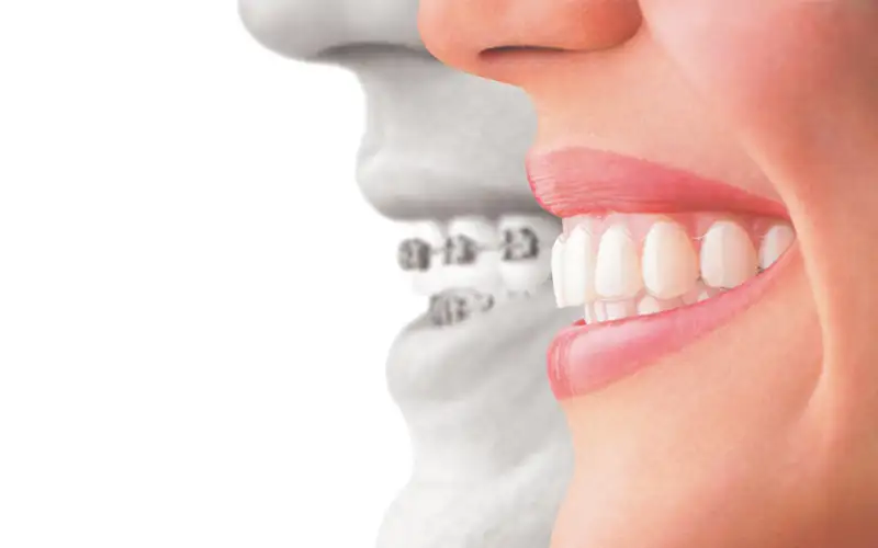 تاثیر ارتودنسی بر سلامت لثه‌ها