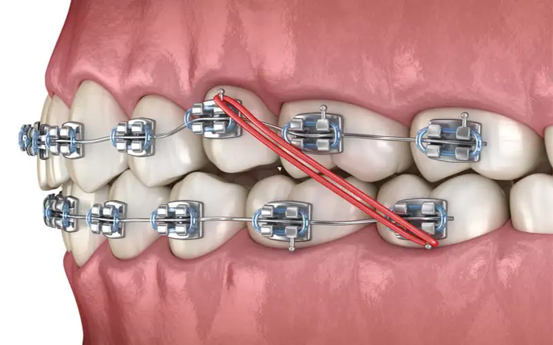 لبخند زیبا با ارتودنسی