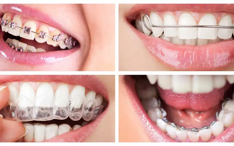 انواع روش های ارتودنسی