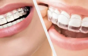 مقایسه نتایج درمان با براکت‌های خودلیگیتینگ و براکت‌های مرسوم