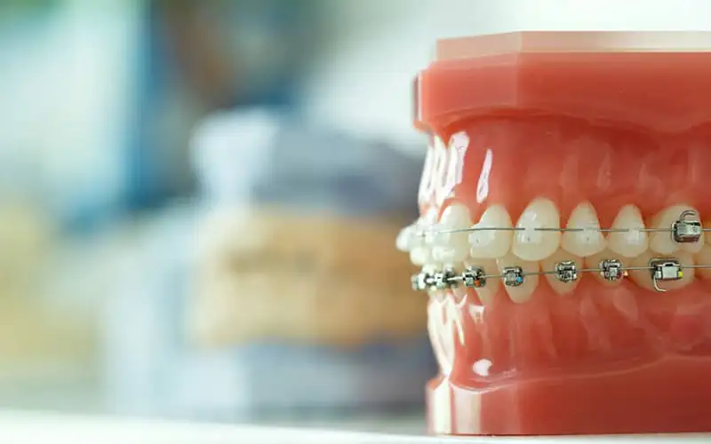 عوارض احتمالی ارتودنسی