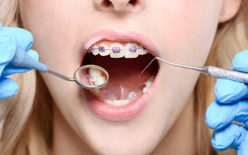 بهترین سن برای ارتودنسی