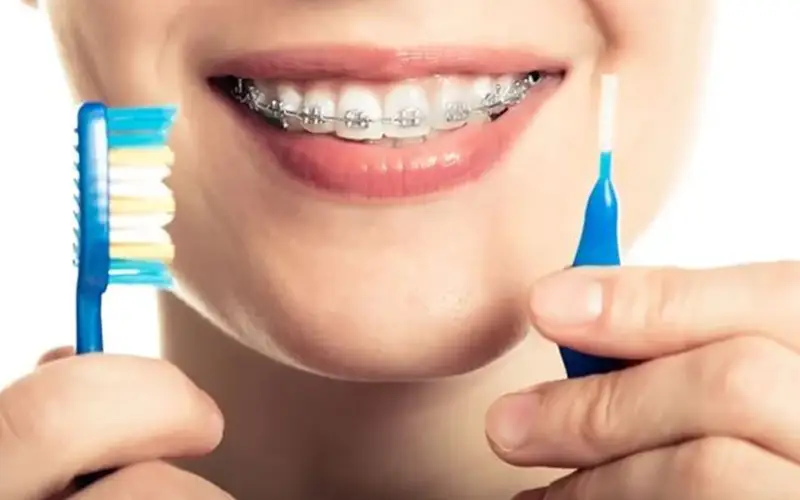 مراقبت از بریس‌های ارتودنسی