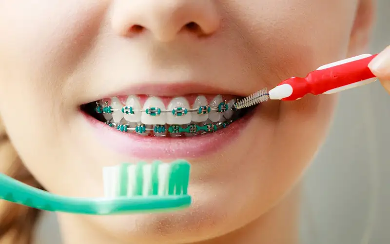 مراقبت‌های لازم در طول درمان ارتودنسی