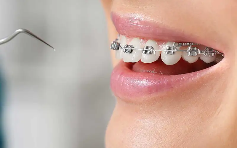 مراقبت دندان بعد از ارتودنسی