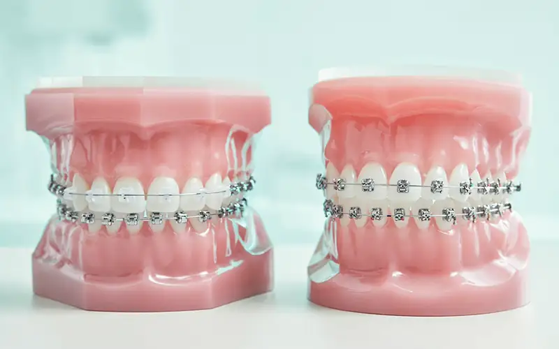 ارتودنسی نامرئی