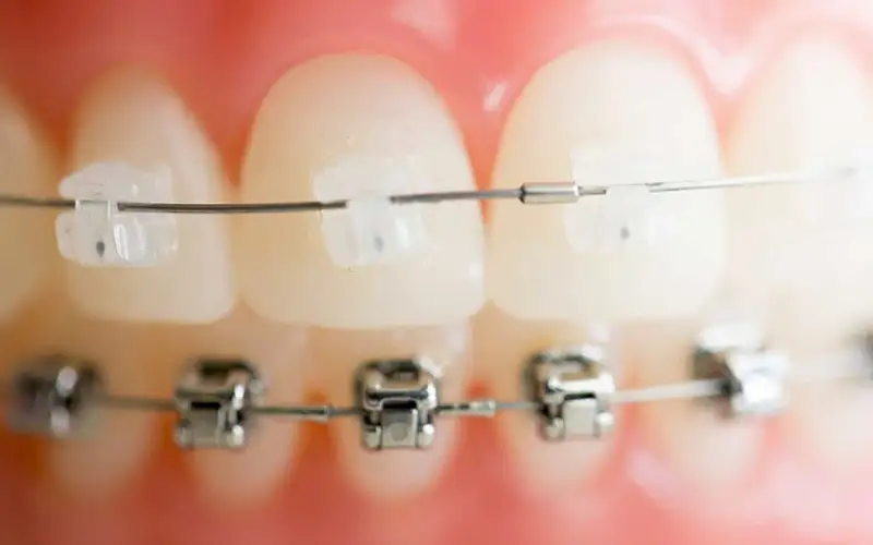 تفاوت ارتودنسی سنتی و دیمون