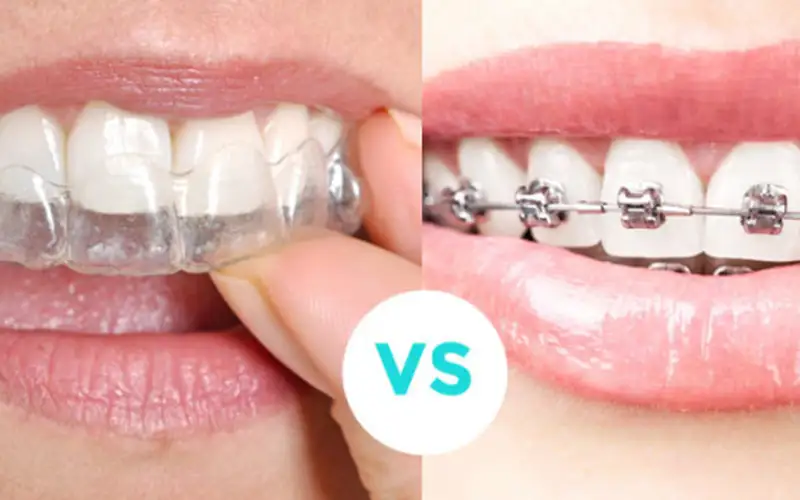 مقایسه ارتودنسی ثابت و متحرک