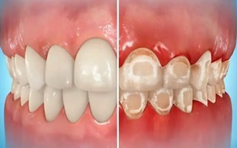 تاثیر ارتودنسی بر سلامت دهان و دندان