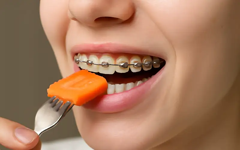 بهبود جویدن، صحبت کردن و لبخند با ارتودنسی