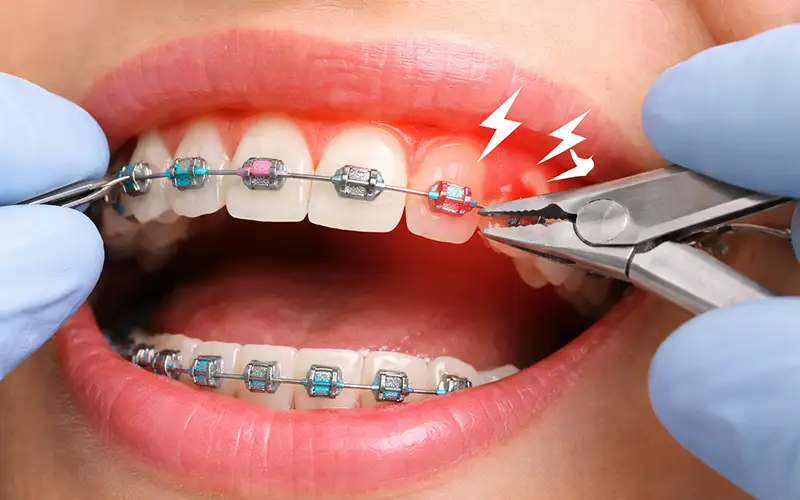 مقابله با درد و حساسیت پس از تنظیم ارتودنسی