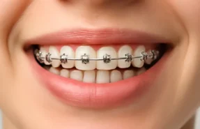 بهبود جویدن، صحبت کردن و لبخند با ارتودنسی