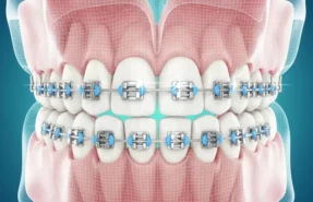 ارتودنسی فک بالا و پایین