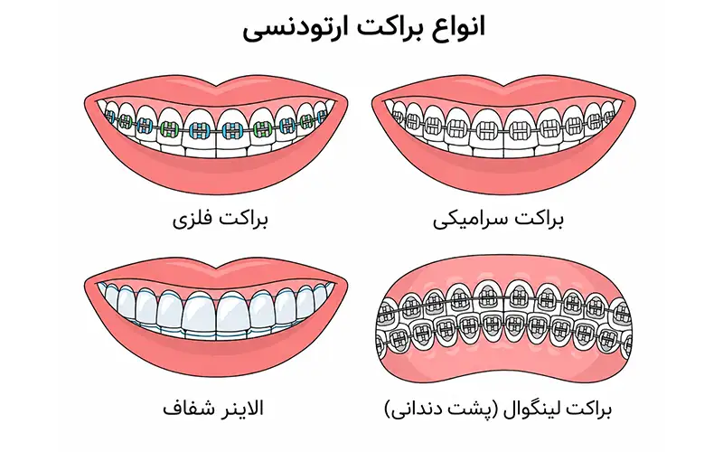 ارتودنسی پشت دندانی؛ بررسی کامل روش لینگوال